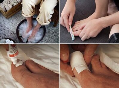 Dämpfende Füße und Auftragen von Harnstoffcreme auf von Pilzen betroffene Nägel