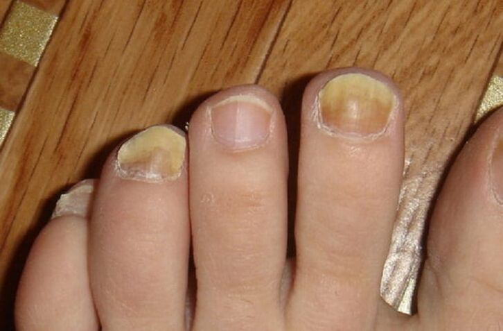Symptome von Pilzen auf den Nägeln und der Haut der Füße