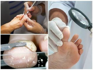 Pilz der Haut des Fußes Diagnostik
